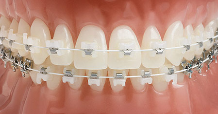 ceramic_braces