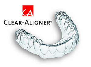 clear_aligner