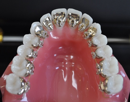 lingual_braces